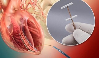Novel Revivent™ Myocardial Anchoring System from BioVentrix Uses Solvay's Zeniva® PEEK in Tether Component Novel Revivent™ Myocardial Anchoring System from BioVentrix Uses Solvay's Zeniva® PEEK in Tether Component