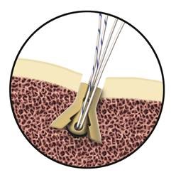 MedShape's Novel Orthopedic Implants Are Made of Solvay’s Zeniva® PEEK