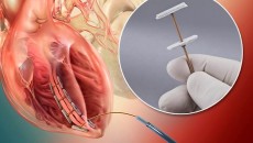 Novel Revivent™ Myocardial Anchoring System from BioVentrix Uses Solvay's Zeniva® PEEK in Tether Component