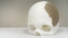 OPM's 3D printing OsteoFab receives USFDA clearance for implants
